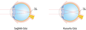 Sağlıklı ve kusurlu göz gelen ışın.png