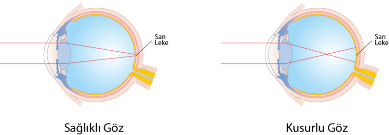 Dosya:Sağlıklı ve kusurlu göz gelen ışın.png